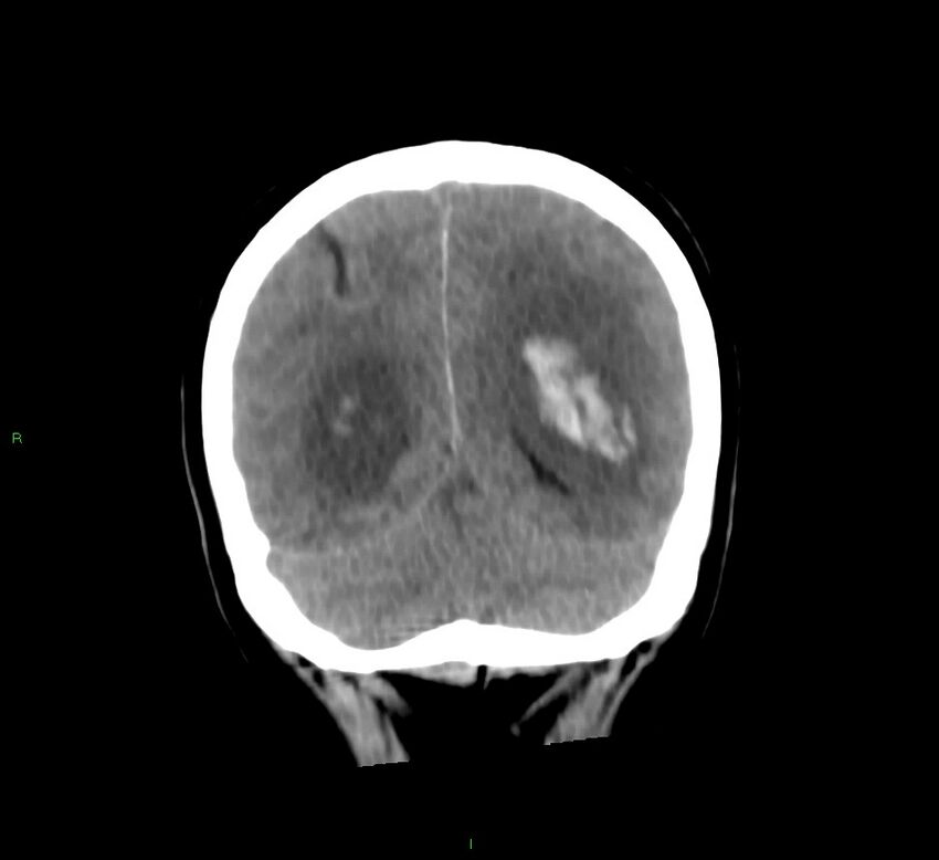 Basal ganglia hemorrhage (Radiopaedia 58775-66008 Coronal non-contrast 18).jpg