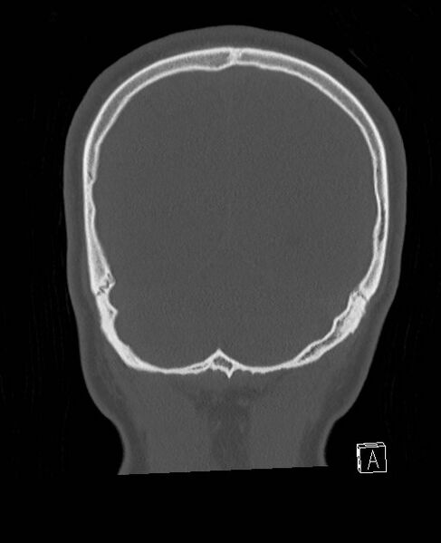File:Base of skull fracture with bilateral Le Fort fractures (Radiopaedia 47094-51638 Coronal bone window 18).jpg