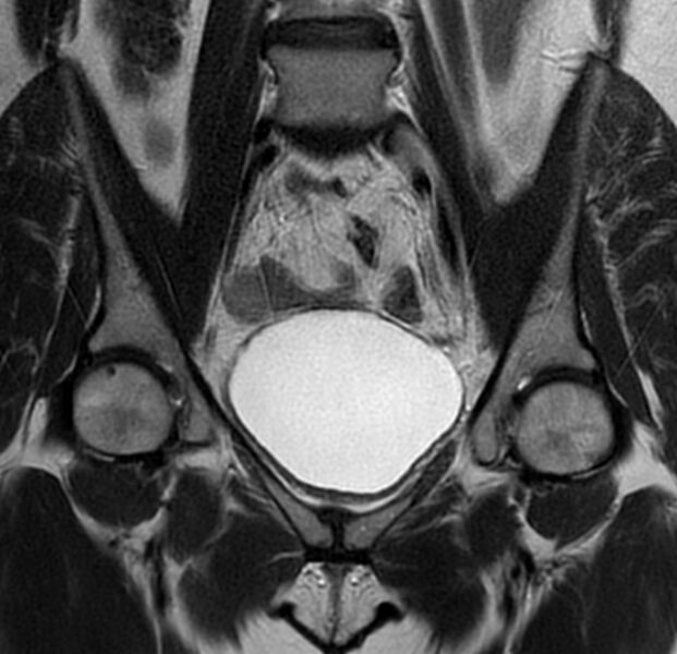 File:Bicornuate uterus (Radiopaedia 76407-88114 Coronal T2 7).jpg