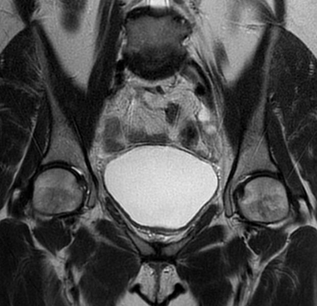 File:Bicornuate uterus (Radiopaedia 76407-88114 Coronal T2 8).jpg