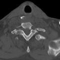 Bilateral C6-7 locked facet dislocation (Radiopaedia 28506-28748 Axial bone window 31).jpeg