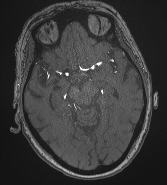File:Bilateral fetal posterior communicating arteries (Radiopaedia 41286-44102 Axial MRA 86).png