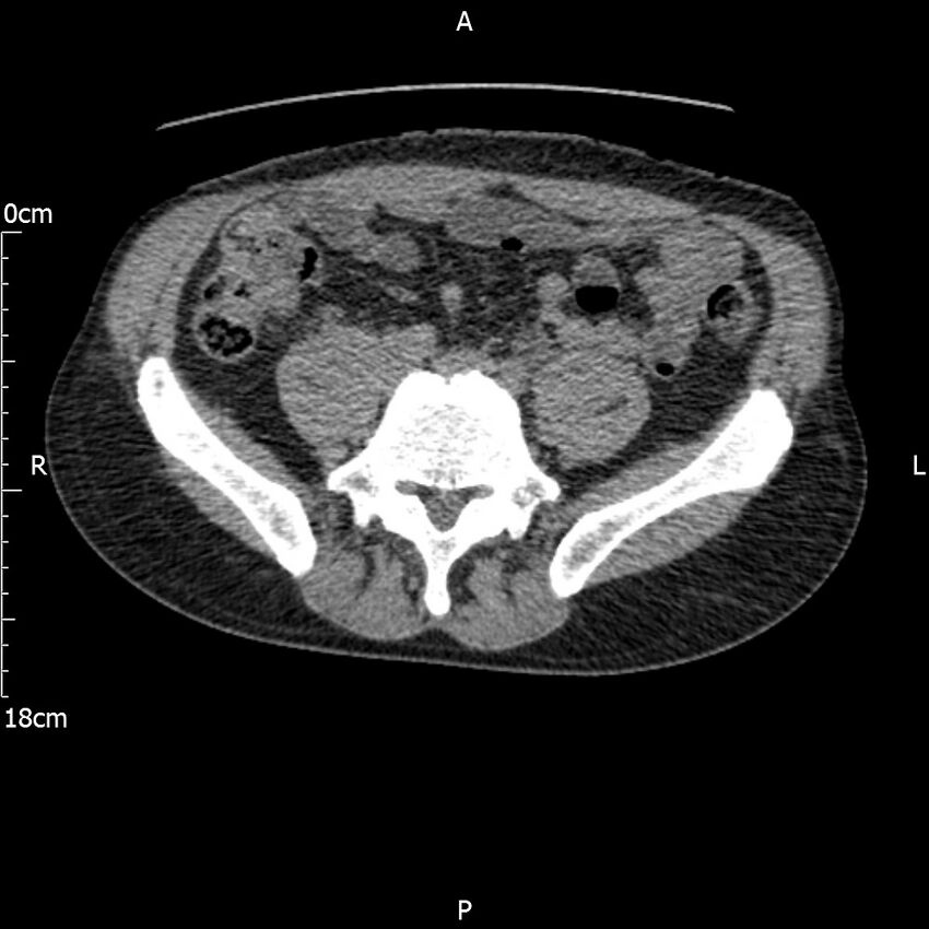 Bilateral medullary nephrocalcinosis with ureteric calculi (Radiopaedia 71269-81569 Axial non-contrast 87).jpg