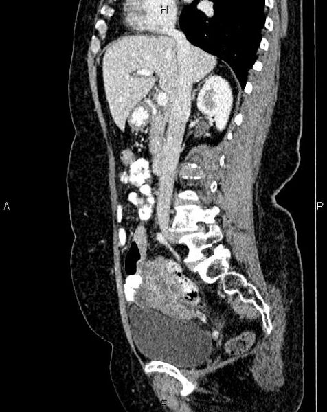 File:Bilateral ovarian serous cystadenocarcinoma (Radiopaedia 86062-101989 E 33).jpg