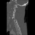Bilateral perched facets with cord injury (Radiopaedia 45587-49713 Sagittal bone window 35).jpg