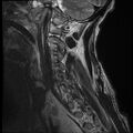 Bilateral perched facets with cord injury (Radiopaedia 45587-49714 Sagittal T2 14).jpg