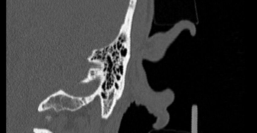 Bilateral temporal bone fractures (Radiopaedia 29482-29970 B 92).jpg