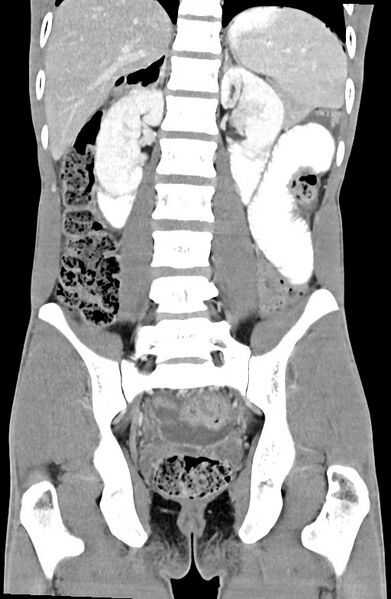File:Blunt injury to the small bowel (Radiopaedia 74953-85987 B 64).jpg