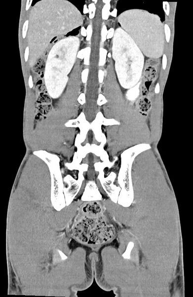 File:Blunt injury to the small bowel (Radiopaedia 74953-85987 B 73).jpg