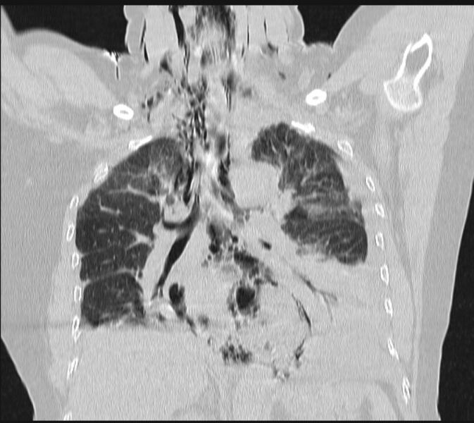 File:Boerhaave syndrome (Radiopaedia 45644-49799 Coronal lung window 39).jpg