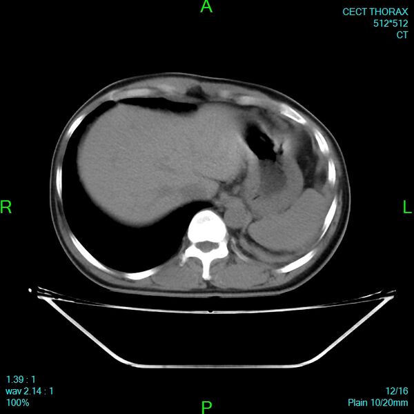 File:Bone metastases from lung carcinoma (Radiopaedia 54703-60937 Axial non-contrast 11).jpg