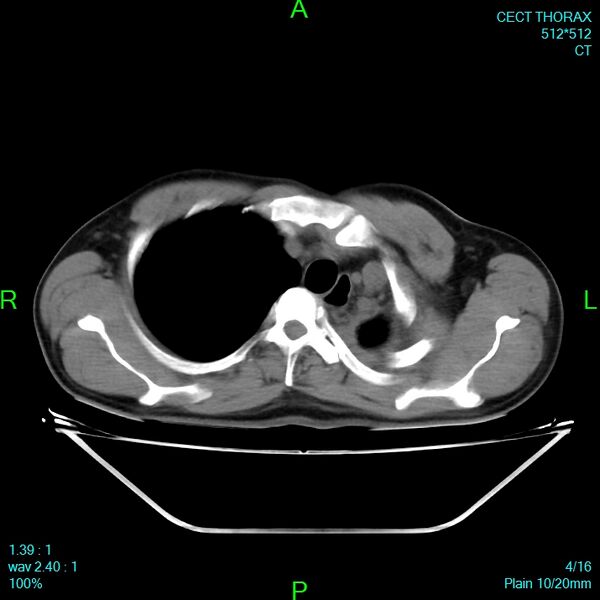 File:Bone metastases from lung carcinoma (Radiopaedia 54703-60937 Axial non-contrast 4).jpg