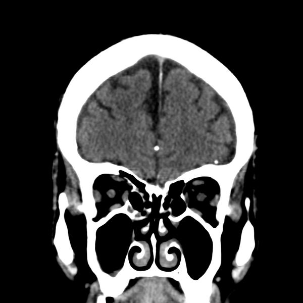 File:Brain Pantopaque remnants (Radiopaedia 78403-91048 Coronal non-contrast 17).jpg