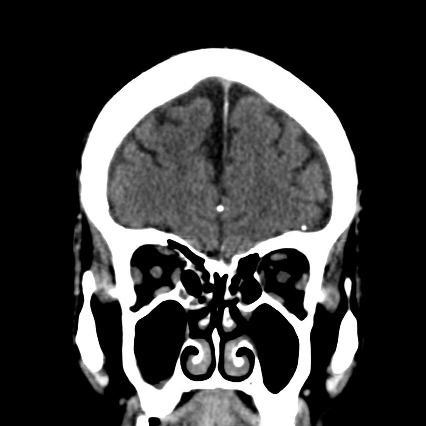 Brain Pantopaque remnants (Radiopaedia 78403-91048 Coronal non-contrast 17).jpg