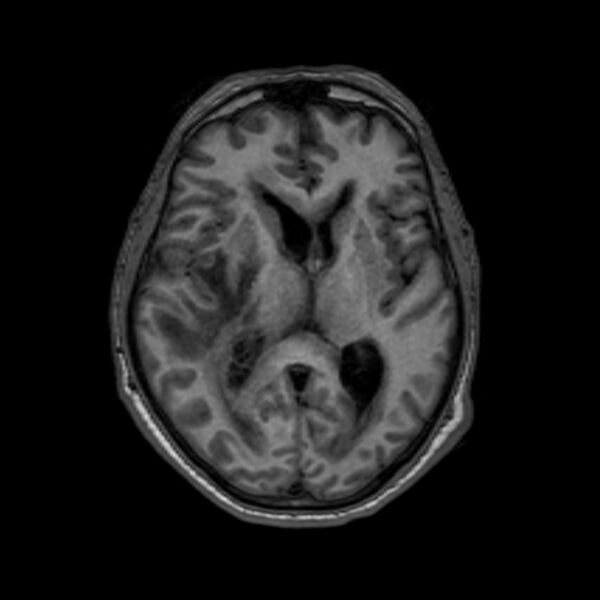 File:Brain abscess complicated by intraventricular rupture and ventriculitis (Radiopaedia 82434-96577 Axial T1 35).jpg