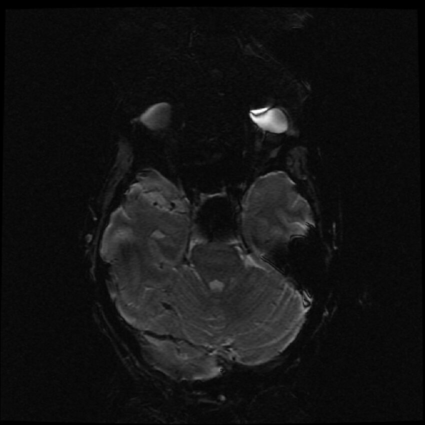 Brain metastases (renal cell carcinoma) (Radiopaedia 42571-45704 Axial SWI 44).jpg