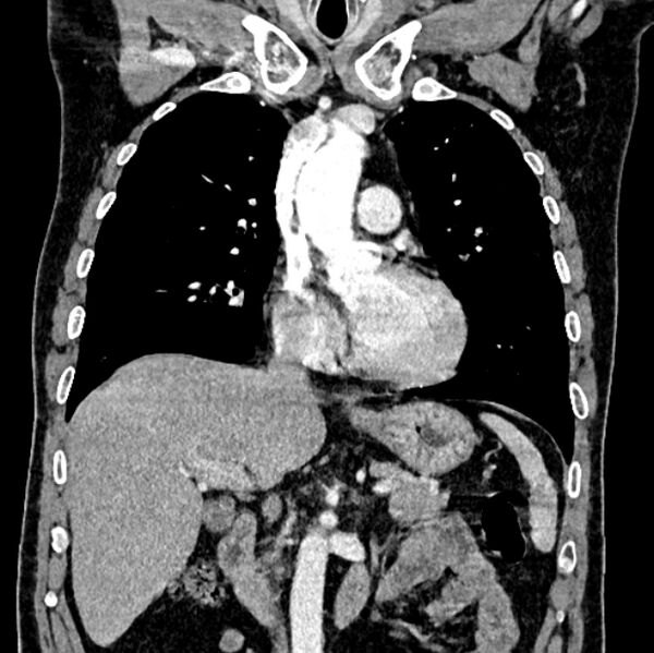 File:Brain metastases - lung cancer primary (Radiopaedia 75060-86116 C+ arterial phase 27).jpg