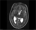 Brainstem glioma (Radiopaedia 21819-21775 Axial T2 19).jpg