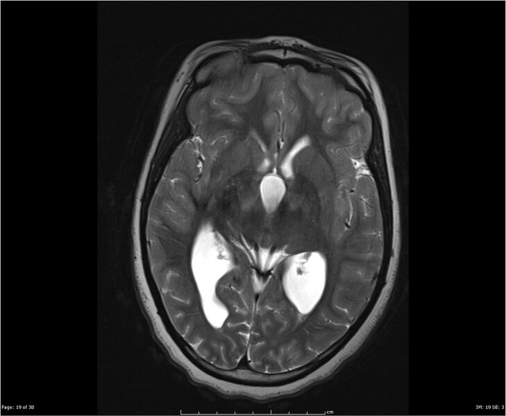 File:Brainstem glioma (Radiopaedia 21819-21775 Axial T2 19).jpg