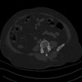Breast carcinoma with pathological hip fracture (Radiopaedia 60314-67993 Axial bone window 5).jpg