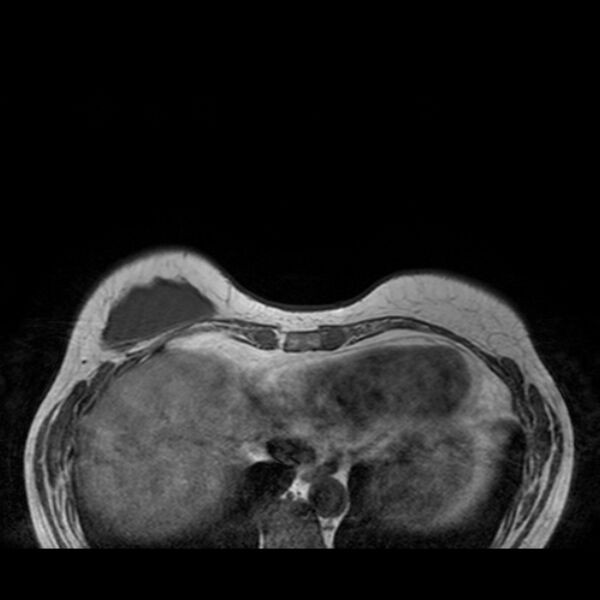 File:Breast implants - MRI (Radiopaedia 26864-27035 Axial T1 9).jpg