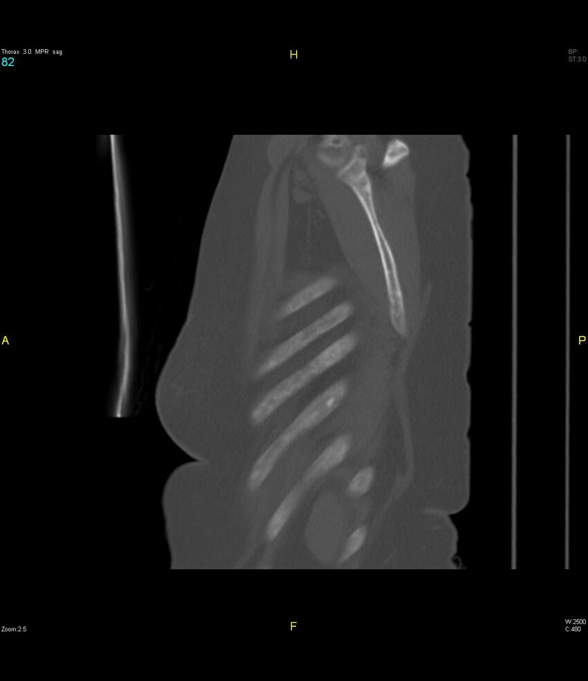 Breast primary with lung and bone metastases (Radiopaedia 40620-43228 Sagittal bone window 82).jpg
