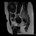 Broad ligament fibroid (Radiopaedia 49135-54241 Sagittal T2 20).jpg