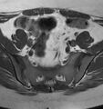 Broad ligament leiomyoma (Radiopaedia 81634-95516 Axial T1 5).jpg