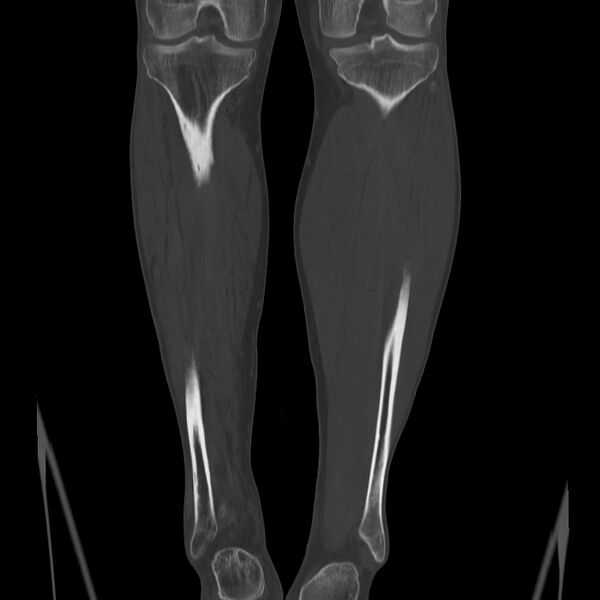 File:Brodie abscess - tibia (Radiopaedia 66028-75204 Coronal bone window 49).jpg