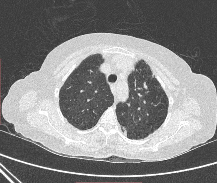 Bronchiectasis (Radiopaedia 72693-83293 Axial lung window 26).jpg