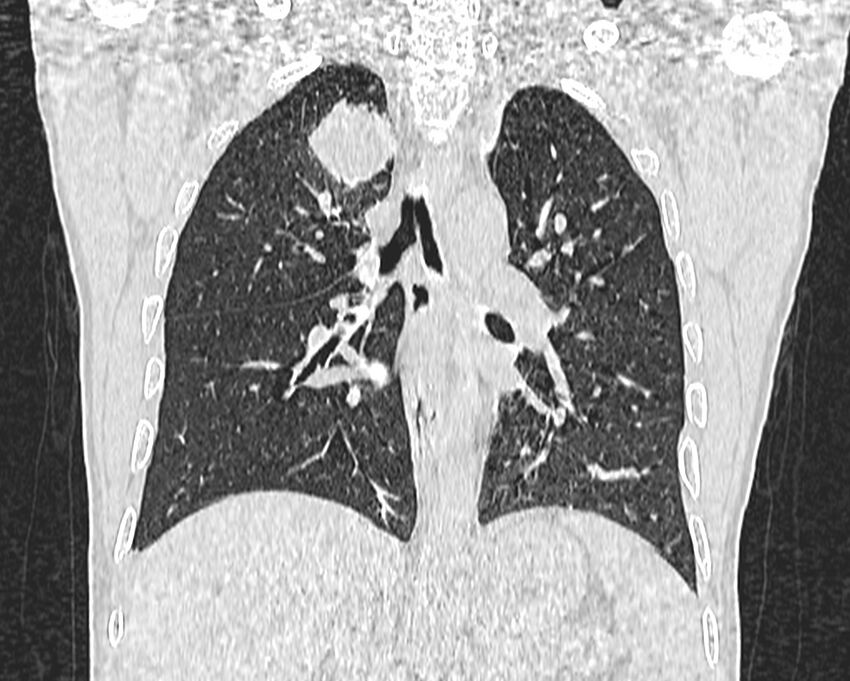 Bronchogenic carcinoma with superior vena cava syndrome (Radiopaedia 36497-38054 Coronal lung window 55).jpg