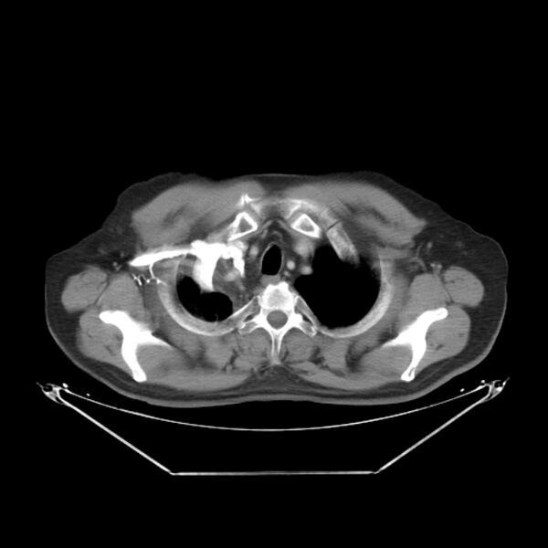 File:Bronchogenic carcinoma with upper lobe collapse (Radiopaedia 29297-29726 C 6).jpg