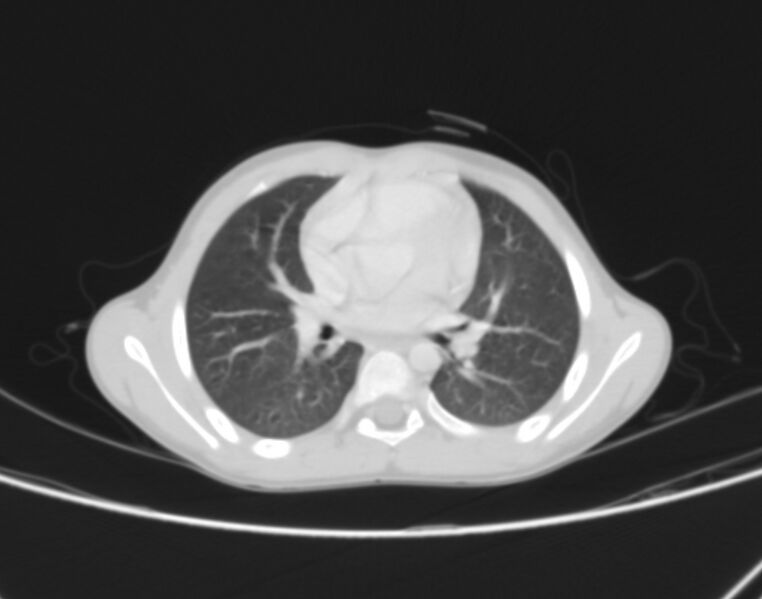 File:Bronchus suis (Radiopaedia 68131-77620 Axial lung window 42).jpg