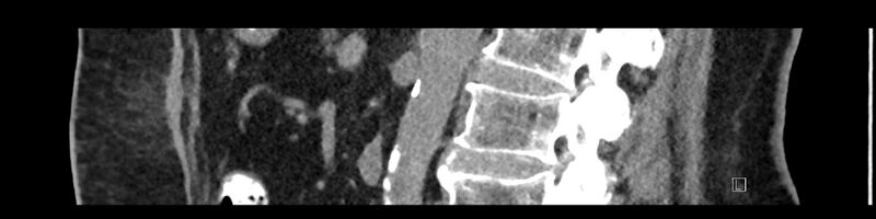 File:Buried bumper syndrome - gastrostomy tube (Radiopaedia 63843-72575 Sagittal Inject 60).jpg