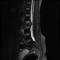 Burst fracture - lumbar spine (Radiopaedia 72877-83541 Sagittal STIR 5).jpg