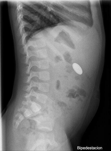 File:Button battery ingestion (Radiopaedia 30986-31681 Lateral 1).png