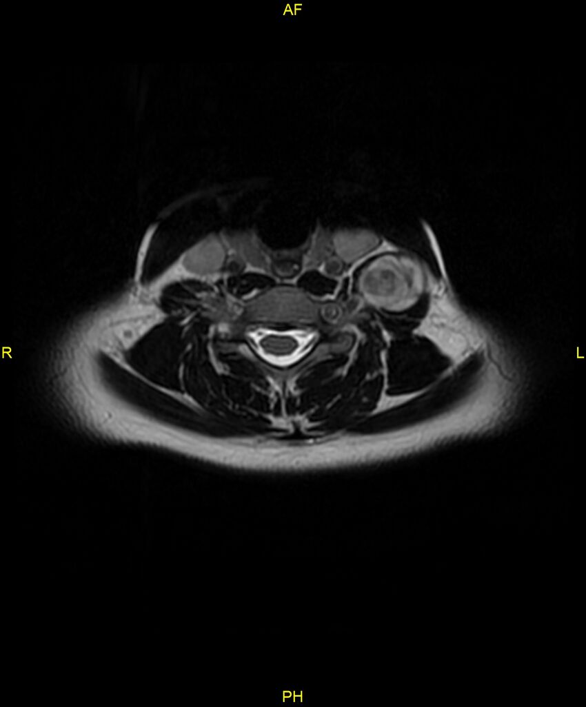 C5 nerve sheath tumor (Radiopaedia 85777-101596 Axial T2 45).jpg
