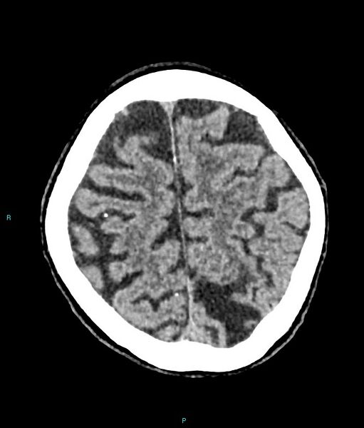 File:Calcified cerebral emboli from left ventricular thrombus (Radiopaedia 84420-99758 Axial non-contrast 22).jpg