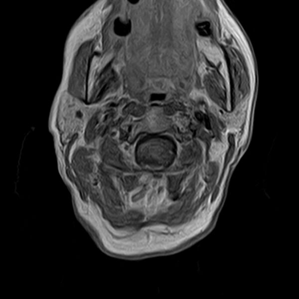 File:Calcified meningioma - cervical canal (Radiopaedia 70136-82468 Axial T1 C+ 10).jpg