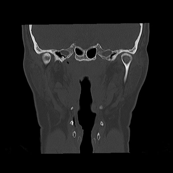 File:Canal up mastoidectomy (Radiopaedia 78108-90638 Coronal bone window 29).jpg