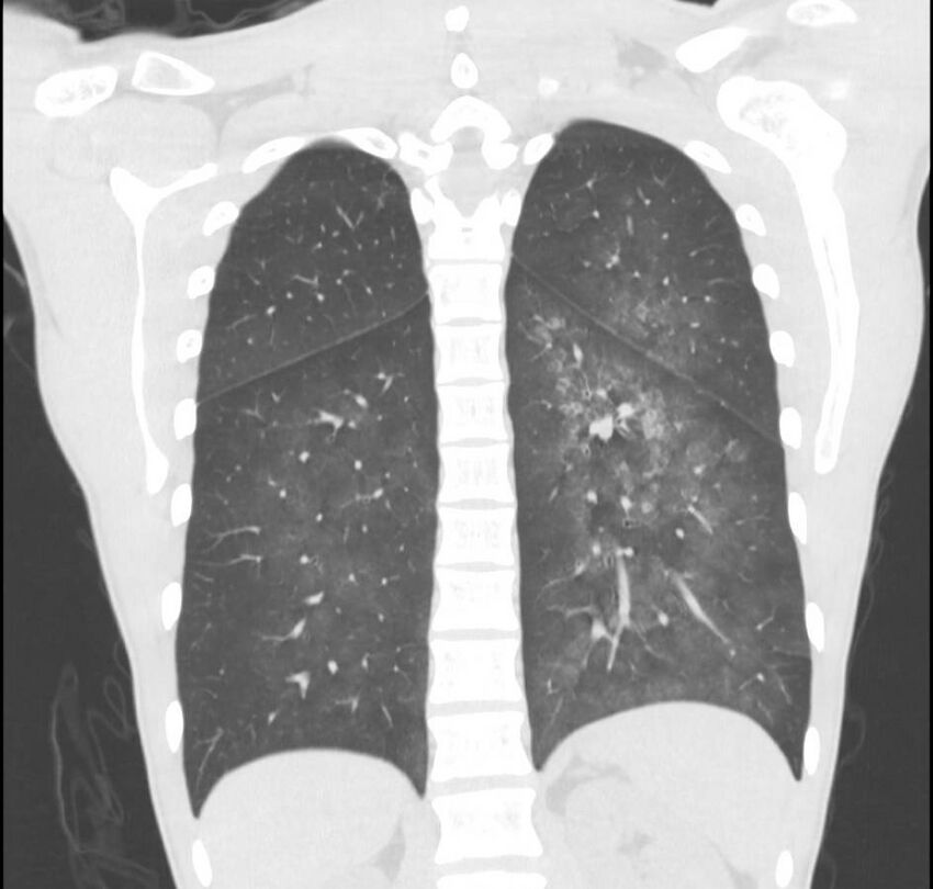 Cannabis-induced diffuse alveolar hemorrhage (Radiopaedia 89834-106946 Coronal lung window 25).jpg