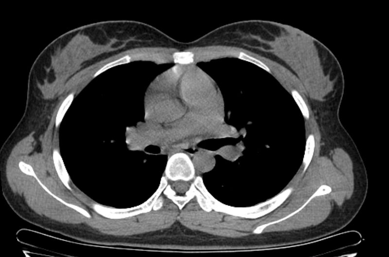 File:Cannonball metastases - uterine choriocarcinoma (Radiopaedia 70137-80173 Axial non-contrast 48).jpg