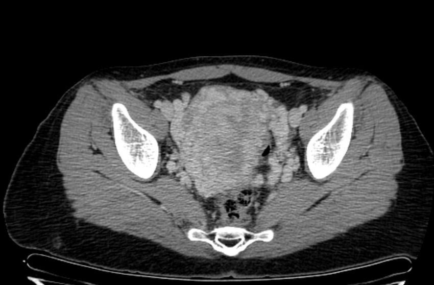 Cannonball metastases - uterine choriocarcinoma (Radiopaedia 70137-80174 A 25).jpg
