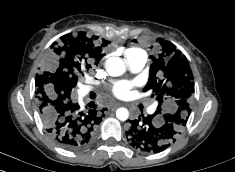 File:Cannonball metastases from breast cancer (Radiopaedia 91024-108569 A 62).jpg