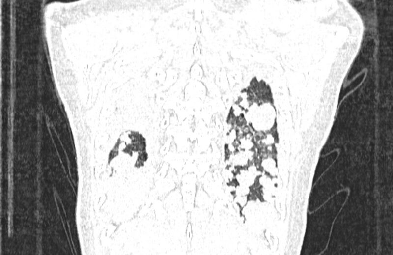 File:Cannonball metastases from breast cancer (Radiopaedia 91024-108569 Coronal lung window 132).jpg