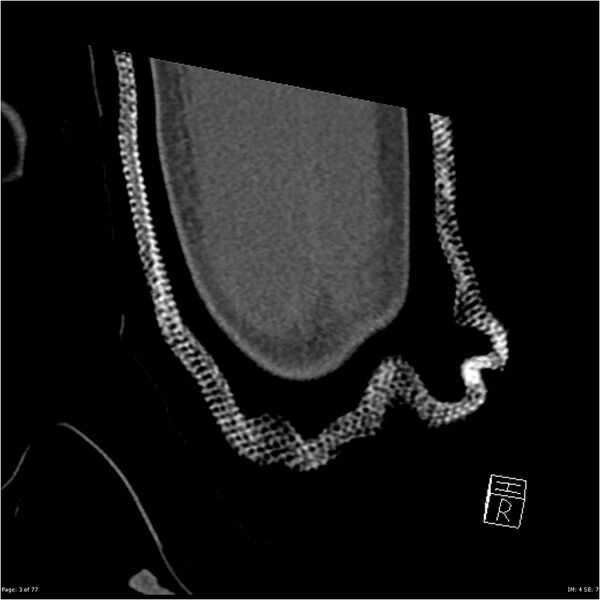 File:Capitellum fracture (Radiopaedia 23352-23426 Coronal bone window 3).jpg