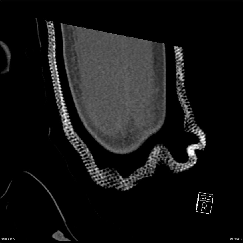 Capitellum fracture (Radiopaedia 23352-23426 Coronal bone window 3).jpg
