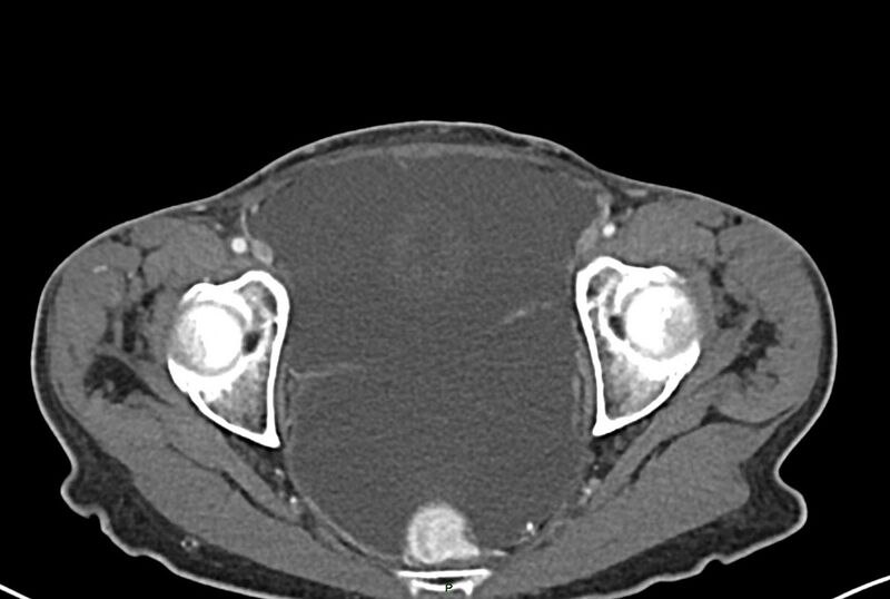 File:Carcinoid mesenteric tumor complicated by chylous ascites (Radiopaedia 76312-87953 A 72).jpg