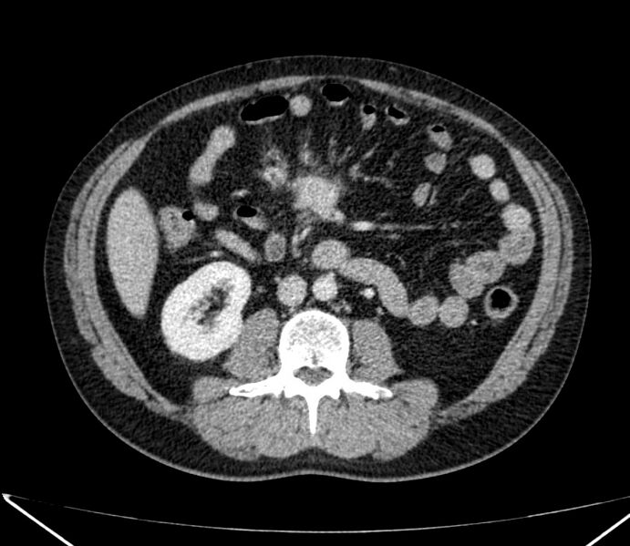 File:Carcinoid tumor with hepatic metastases (Radiopaedia 22651-22670 C 52).jpg