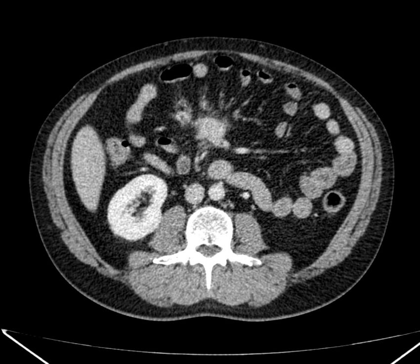 Carcinoid tumor with hepatic metastases (Radiopaedia 22651-22670 C 52).jpg